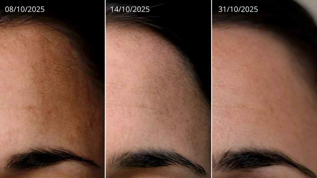 Dermalis® DermoClear Plasma