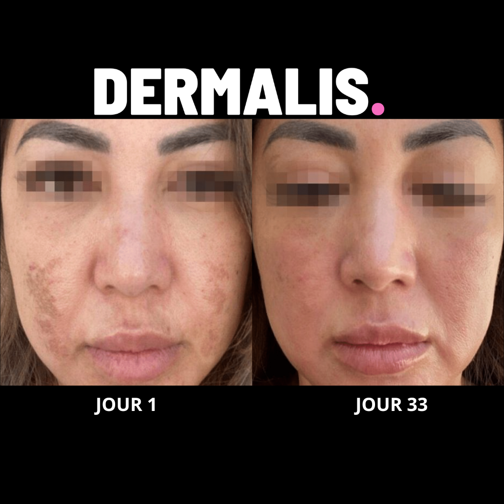 PACK DERMALIS 270 | Masque de Luminothérapie Pro